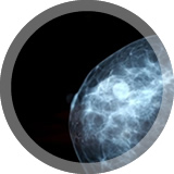 Mamografías